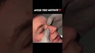 Remove Pimples Permanently ✅ #skin #pimpleproblem #pimplefreeskin #acne