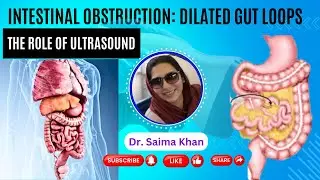 Intestinal Obstruction Dilated gut loops on Ultrasound #ultrasound #doctor #sonologist  @DrSaimaKhan