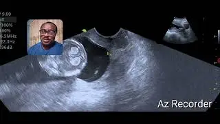 A case of chorioamniotic separation in the first trimester with severe bleeding per vagina.