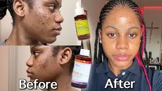 I Tried The Good Molecules Niacinamide Toner & Discoloration Correcting Serum For 30 Days!