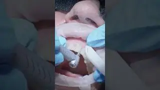 Shrinking lost time with the right dental bur