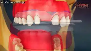 What are Ceramic Bridges? When can they be used?