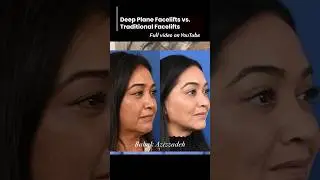 Discover the secret to timeless beauty! Explore the world of Deep Plane vs. Traditional Facelifts ✨