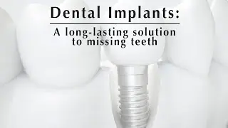 Common Questions About Dental Implants Answered