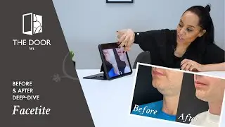 Male Chin & Neck Liposuction with FaceTite | Before and After | Dr Natasha Berridge | The Door W4