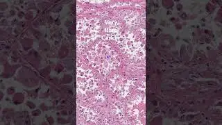 A very rare cancer: Alveolar Soft Part Sarcoma #sarcoma #pathology #microscope #alveolar