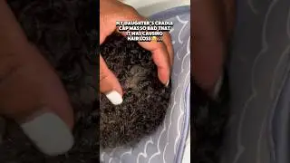 Cradle Cap and Hair Growth: Myth or Fact?