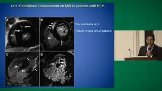 Ventricular Arrhythmias in Hypertrophic Cardiomyopathy