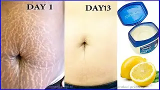 Lemon remedy for stretch marks to remove stretch marks naturally at home 3 Get rid of stretch marks