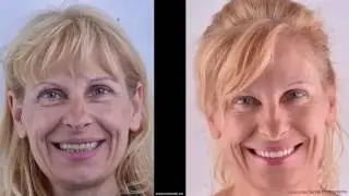 Endomak DSD & Smile Makeover 2016