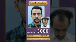 Grade 5 Hair Transplant| Grade 5 Hair Transplant results | Satya clinic #hairtransplantresults