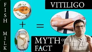 Uncovering the Truth About Vitiligo and the Fish and Milk Myth