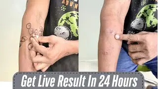 Multiple Lipoma Removal Get Live Result In 24 Hours #lipomatreatment #lipomaremoval #getridoflipoma