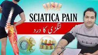 What Is Sciatica? Causes, Symptoms and Best Treatment for Leg Pain | Say Goodbye to Sciatica Pain