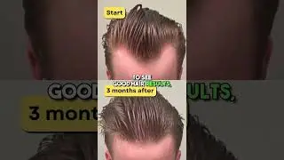 Microneedling your scalp to regrow hair