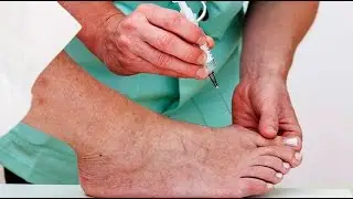 My Personal MD: Are Too Many Cortisone Injections Bad For You? | Podiatry