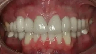 Rigby Advanced Dental (Bee Cave & Lakeway Texas) Ectodermal Dyslplasia Rehabiliation