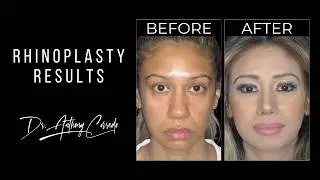 Incredible Natural Rhinoplasty Results: Before & After Reveal | Dr. Anthony Corrado