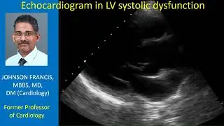 Echocardiogram in left ventricular systolic dysfunction