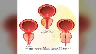 How to Deal With Prostate Disease | Symptoms, Prevention & Treatment Options