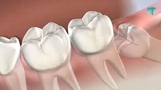Wisdom Teeth Removal in Foster City, CA | Foster City Oral Surgery Specialists