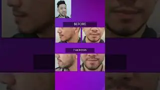 His results are immaculate!  #baldnesssolution #fuehairtransplant #smartfue #fue #hairloss #hair