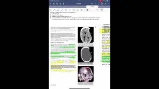 Sunken flap syndrome Syndrome of trephined