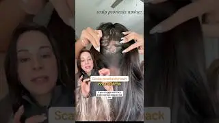 Scalp Psoriasis HACK &mdash; From A Derm | #shorts #skincare |
