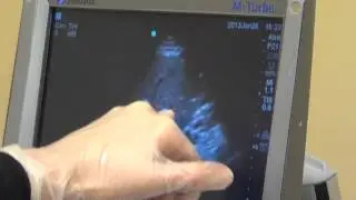 Gallbladder Ultrasound evaluation