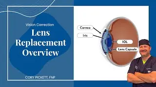 Lens Replacement Overview
