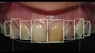 Smile Design - Faccette - Extreme Makeover