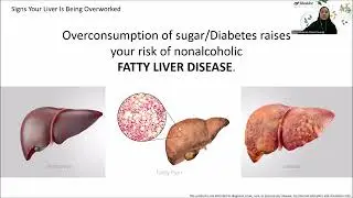 Let's Learn About Liver - Signs That Your Liver is Being Overworked (ENG)
