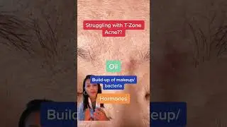 Struggling with t-zone acne? || #shorts