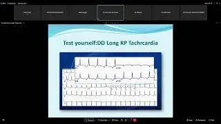 Narrow Complex Tachycardia   Dr  Mohamed Adam