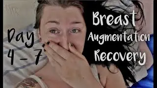 Day 4-7 Breast Augmentation Recovery | MtF