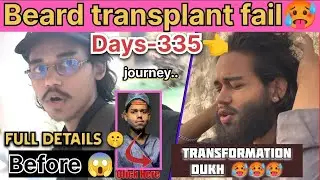 Beard Transplant Fail😱 Days-335 🥵 Result Condition Journey 🙏