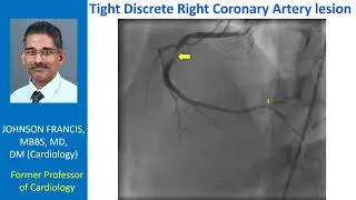 Tight discrete Right Coronary Artery lesion