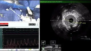 BRAZILIAN SOCIETY FOR HEMODYNAMICS AND INTERVENTIONAL CARDIOLOGY (SBHCI) VIRTUAL CONGRESS 2020