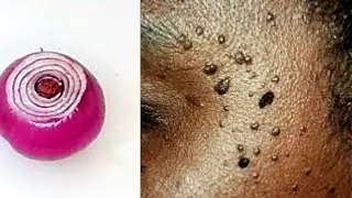 3 min REMOVE SKIN TAG WITH TOOTHPASTE OVERNIGHT SKIN TAG GONE