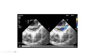 Right Side Obstructive Lesions (part 2 of 2)