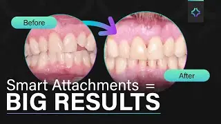 Treating Open Bite & Crossbite with Invisalign&reg;: Step by Step - Ep. 17