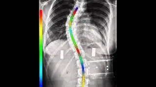 Patient specific mechanical spine properties