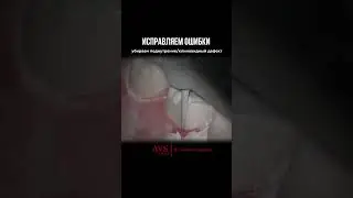 Препарирование под коронку при клиновидном дефекте