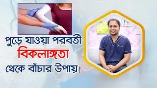 পুড়ে যাওয়া পরবর্তী বিকলাঙ্গতা থেকে বাঁচার উপায়! Plastic Surgeon Zaman Sunny