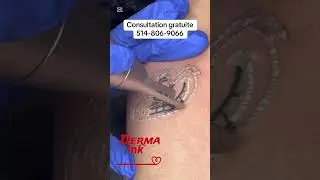 #dermainkdetatouageaulaser #tattoo #picosurelaser #lasertattooremoval #laser