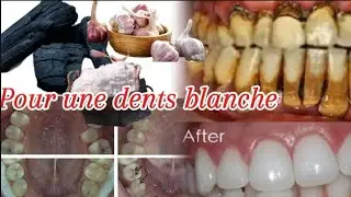 #dents blanche comment faire Pour  blanchire une dent #pourrie en #blanche