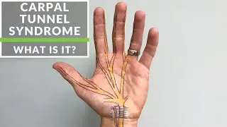 Carpal Tunnel Syndrome