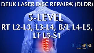 5 LEVELS OF LOWER BACK PAIN - LIVE - Laser Spine Surgery