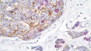 Advances in Breast Cancer Research