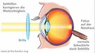 Was ist Weitsichtigkeit? (Hyperopie)